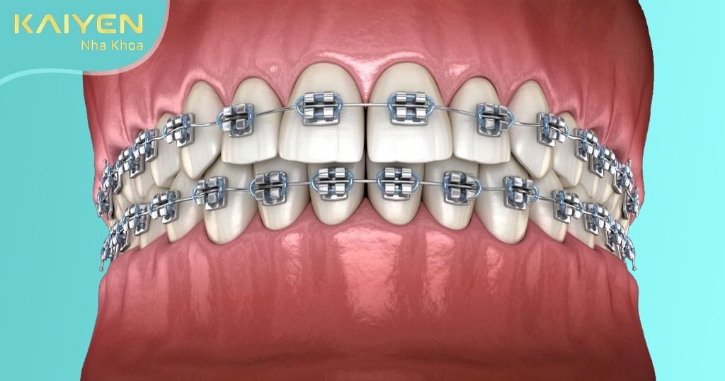 Hô hàm do răng có thể thực hiện niềng