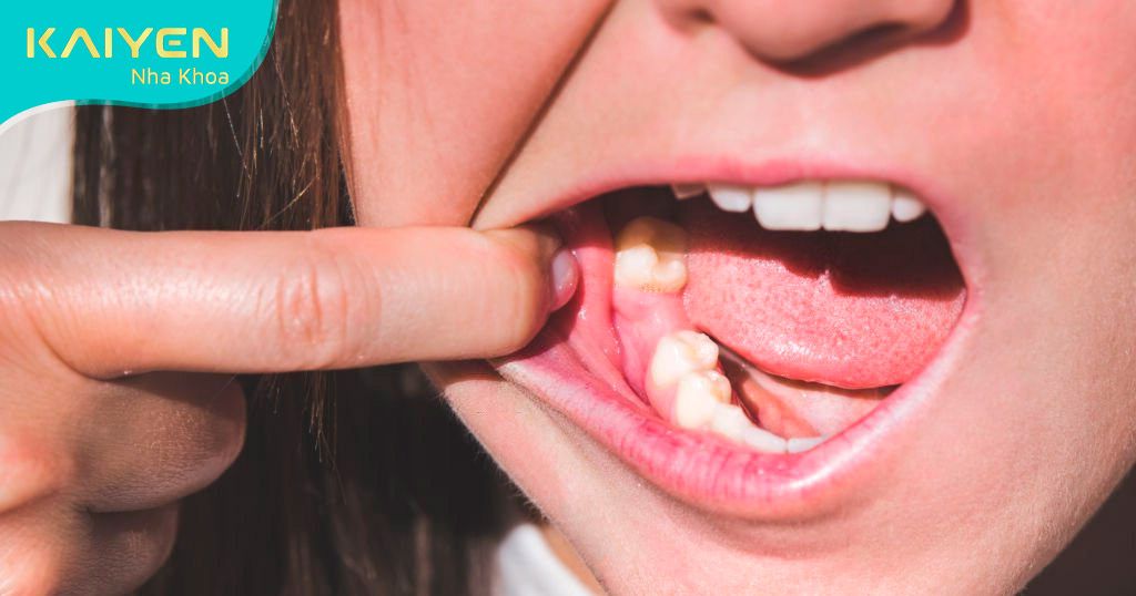 Mất răng làm suy giảm chức năng ăn nhai đáng kể