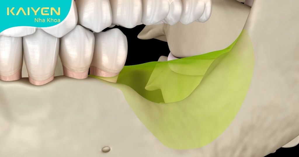 Tiêu xương hàm sau một thời gian mất răng