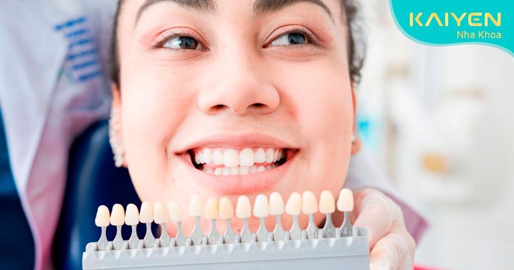 Chia sẻ kinh nghiệm dán răng sứ Veneer được nhiều khách hàng quan tâm