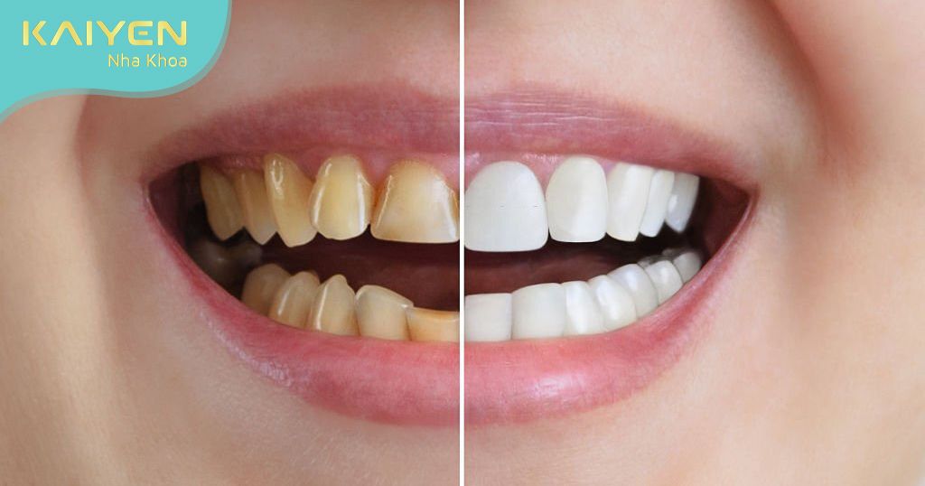 Răng ố vàng, răng khấp khểnh,… đều có thể làm răng sứ