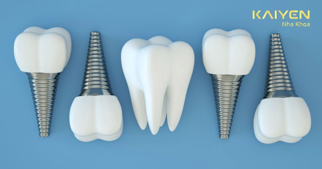 Implant nha khoa - công nghệ trồng răng được ứng dụng trên khắp thế giới