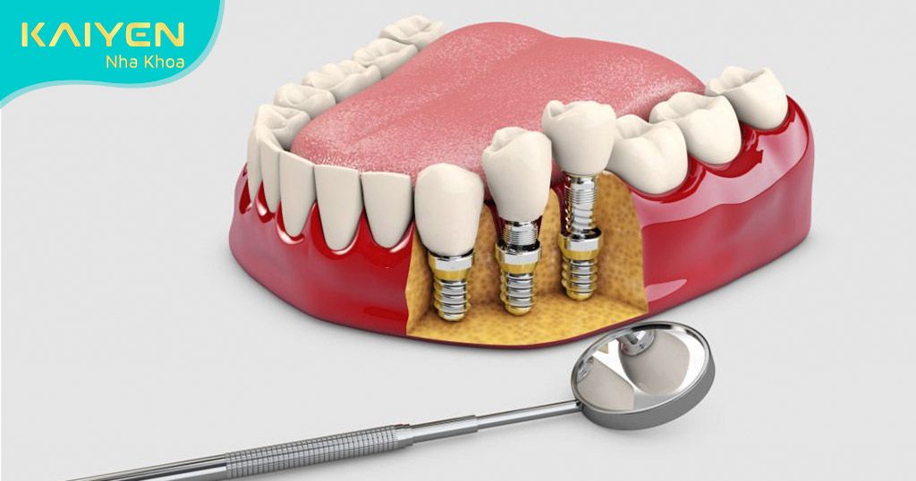 Mất răng gây ảnh hưởng đến sức khỏe và sinh hoạt hàng ngày
