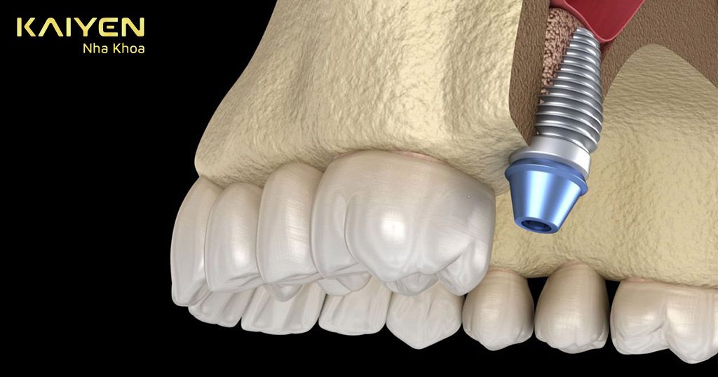 Trồng răng Implant cho răng bị mất lâu năm