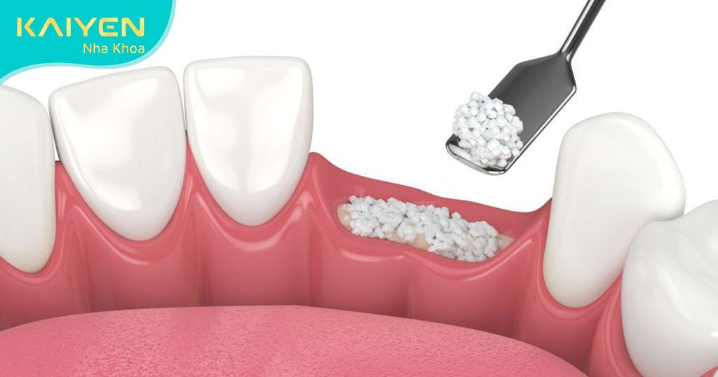 Ghép xương nhân tạo cho người mất răng lâu năm