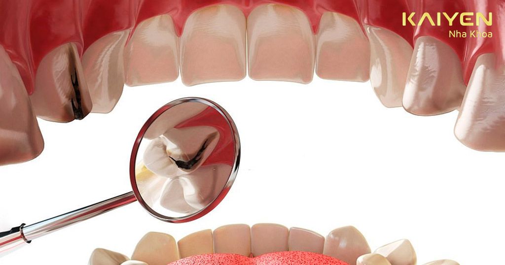 Bị sâu răng cấm do vệ sinh răng miệng không đúng cách