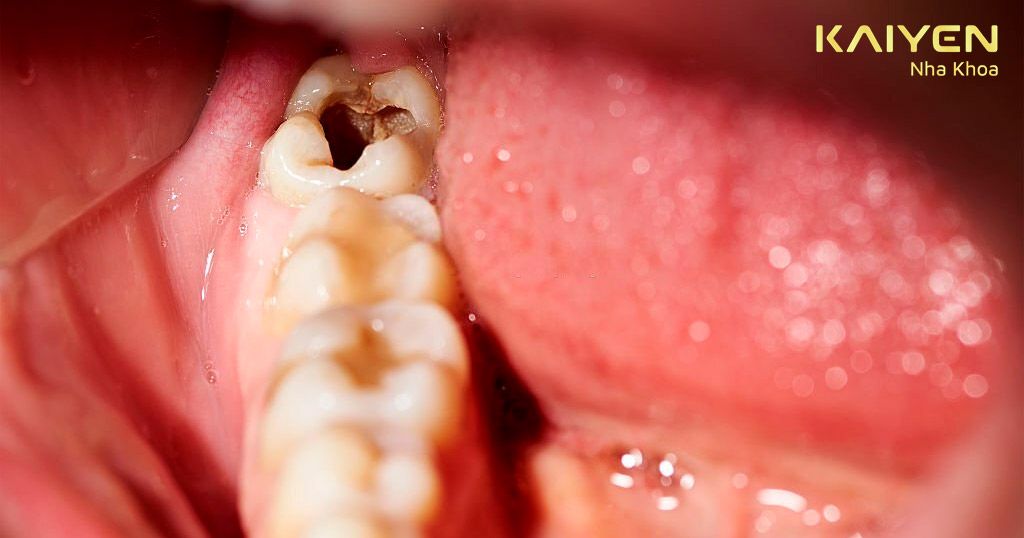 Răng bị sâu xuất hiện những lỗ màu đen trên răng