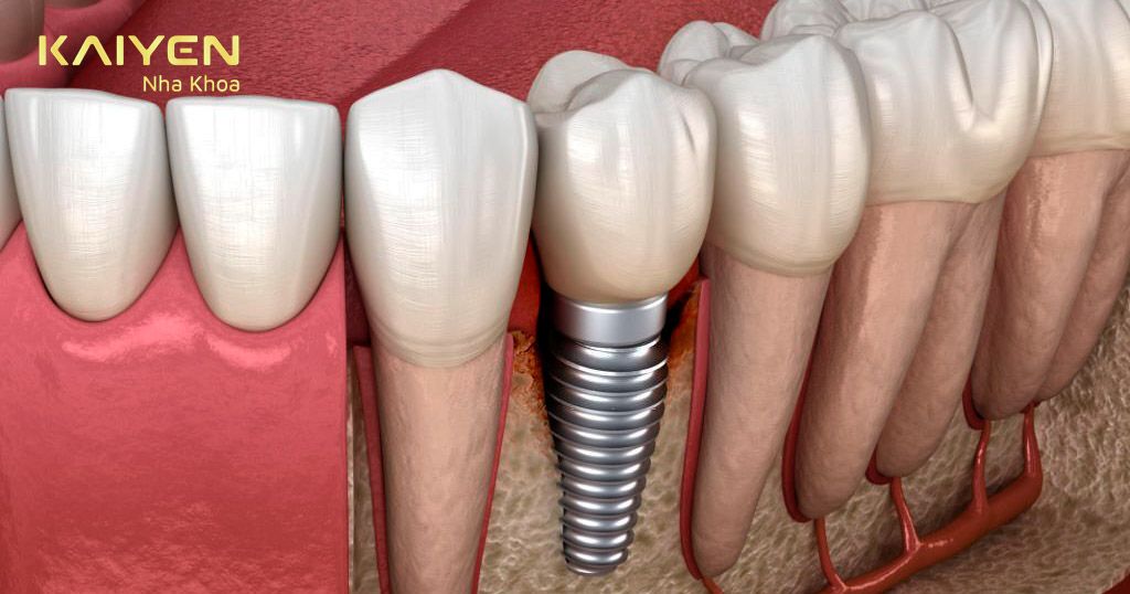 Nguyên nhân khiến răng Implant bị viêm