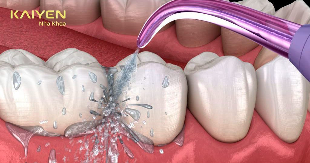 Các biện pháp phòng ngừa viêm quanh răng Implant