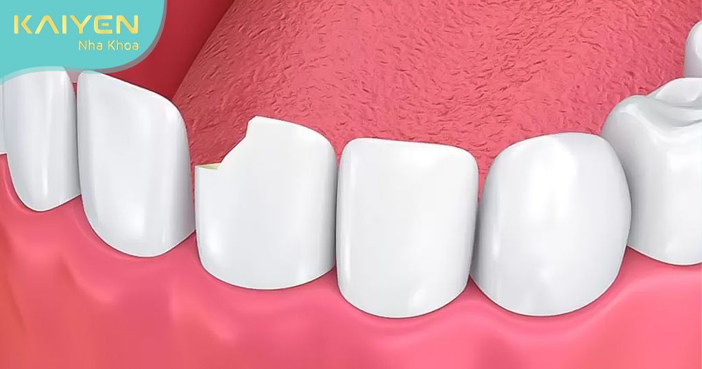 Răng sứ bị sứt mẻ là một dạng của răng sứ hỏng