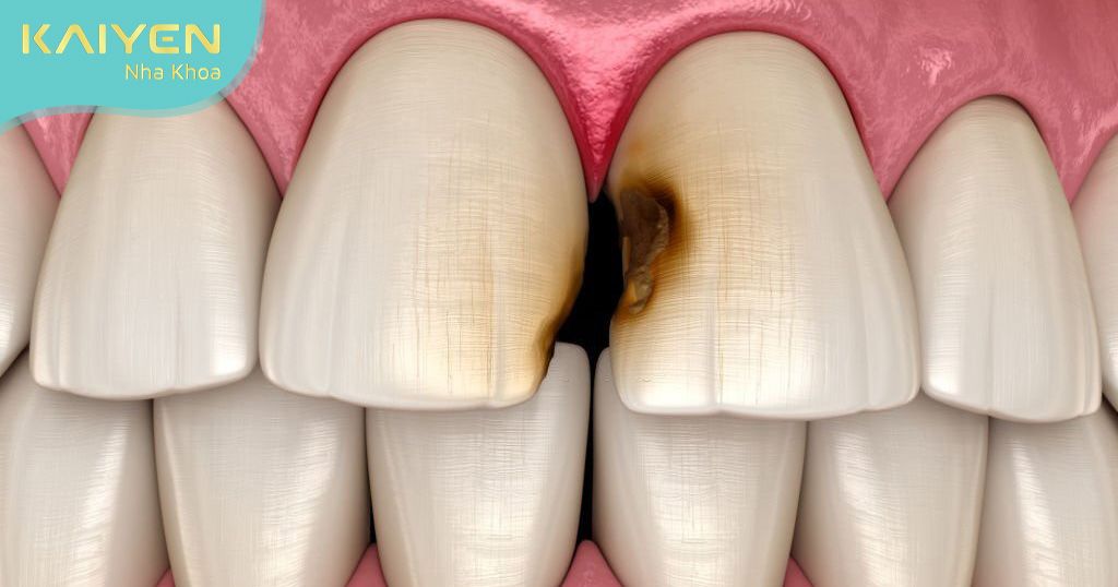 Bác sĩ thực hiện không đúng kỹ thuật khiến răng sứ bị sâu