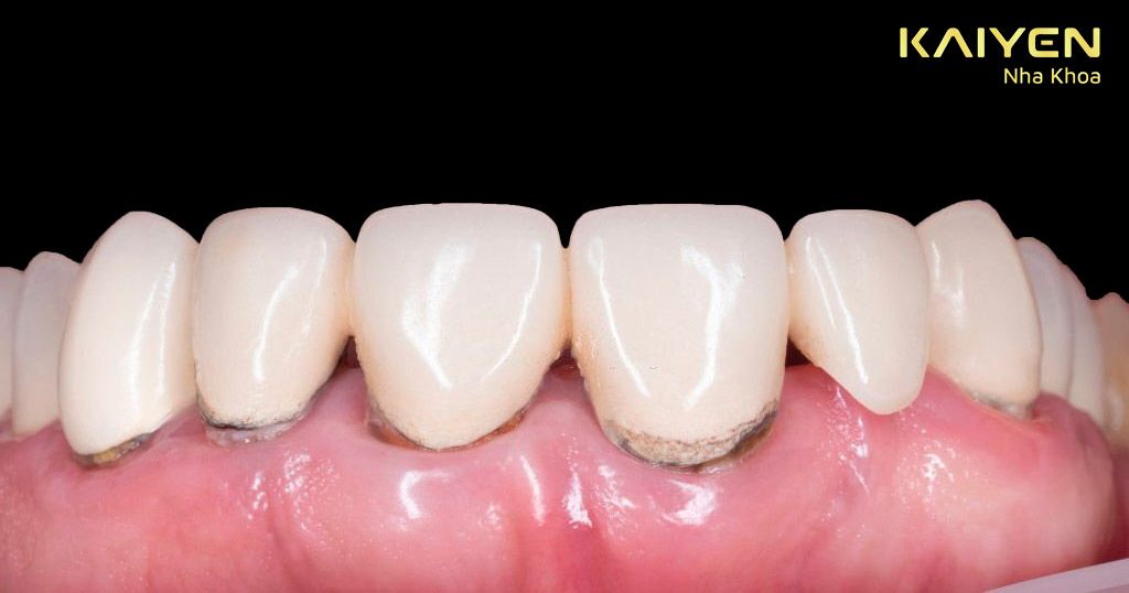 Răng sứ bị hở gây nhiều bệnh lý răng miệng