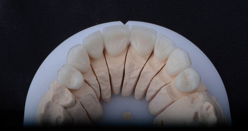 Răng sứ Zirconia phổ biến