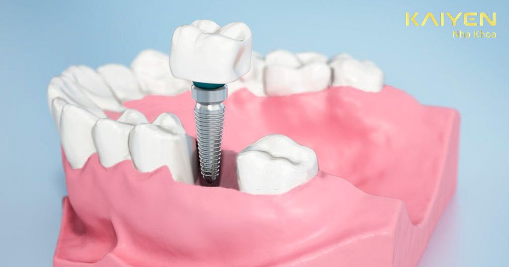 Quá trình trồng răng Implant gồm mấy bước?