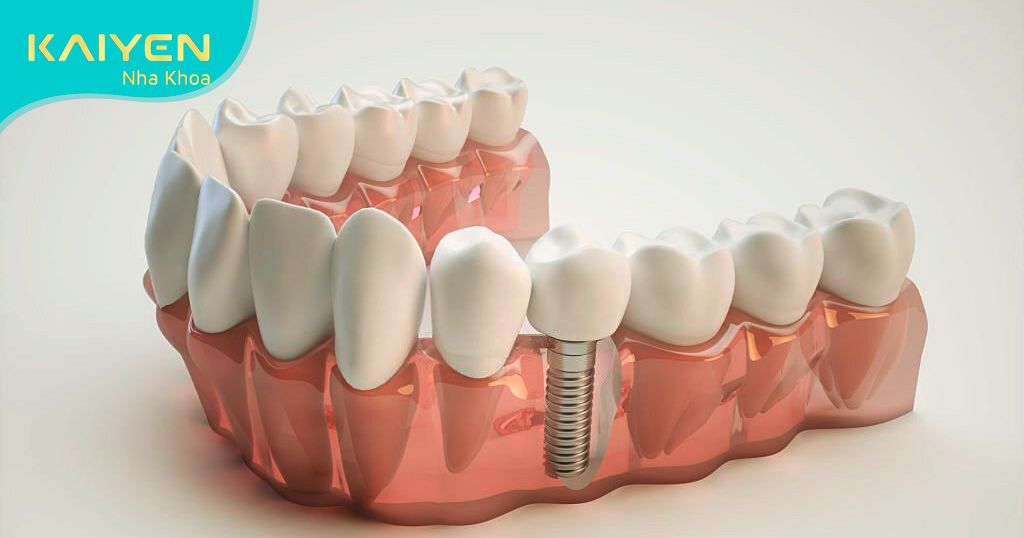 Cấy ghép Implant có khả năng phục hồi cả chân răng và thân răng