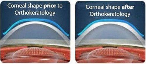 Kính áp tròng cứng và mềm có giống nhau không?