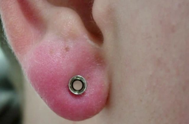 Đeo khuyên tai vàng bị mưng mủ: Nguyên nhân và cách khắc phục