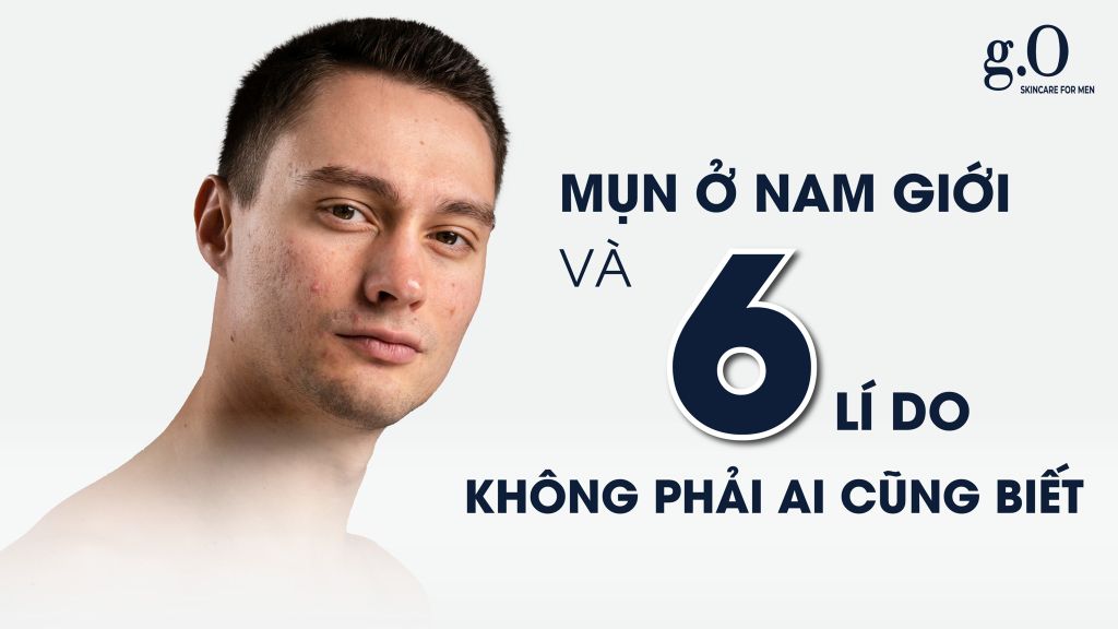 Mụn Ở Nam Giới Và 6 Lí Do Không Phải Ai Cũng Biết