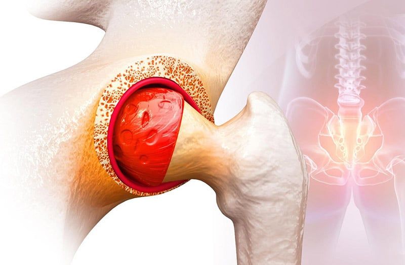 Viêm khớp cùng chậu: Nguyên nhân, triệu chứng và hướng điều trị hiệu quả