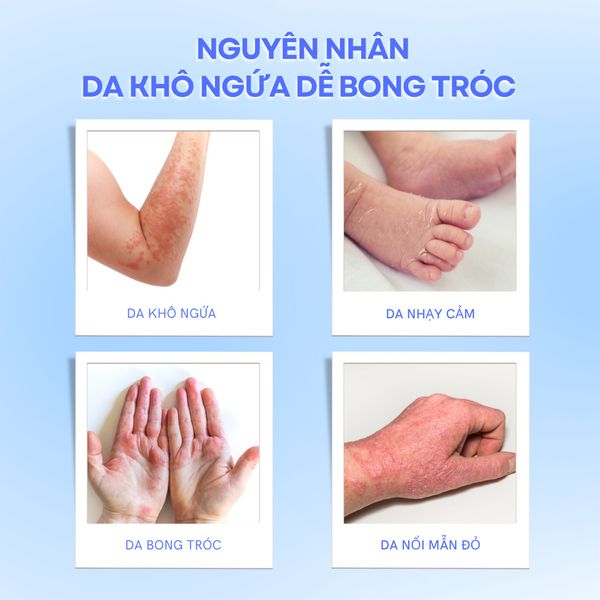 NGUYÊN NHÂN DA KHÔ NGỨA DỄ BONG TRÓC
