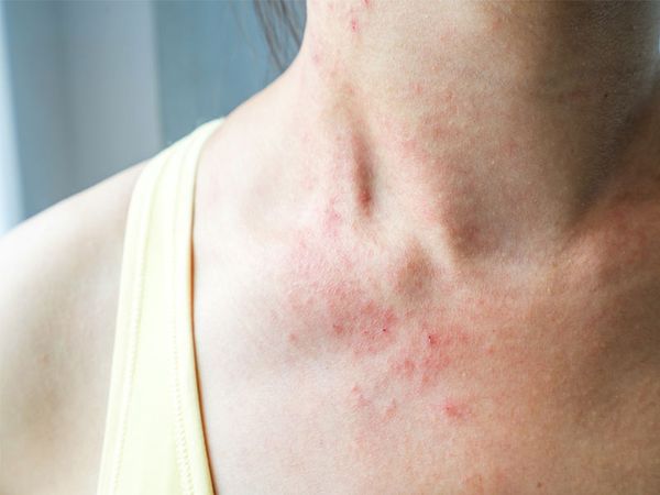 Viêm da cơ địa là gì? Những lưu ý cần biết khi chăm sóc viêm da cơ địa