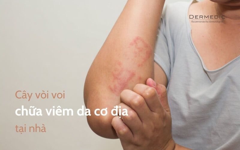 Cây vòi voi chữa viêm da cơ địa tại nhà có hiệu quả không?
