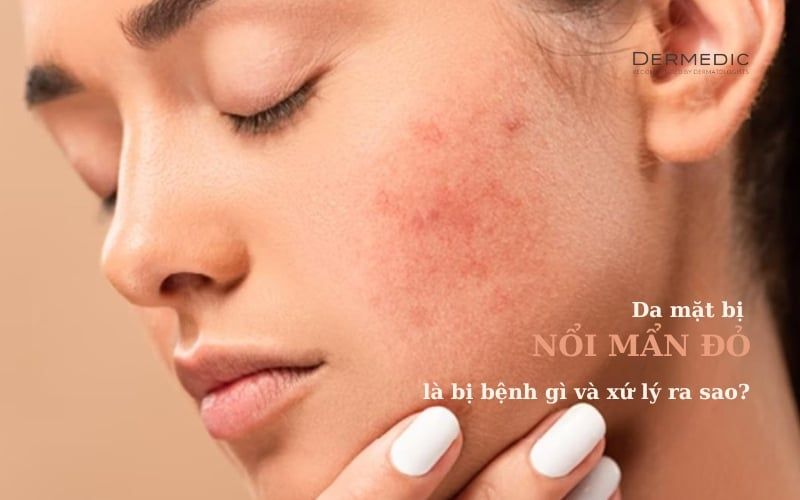 DA MẶT BỊ NỔI MẨN ĐỎ LÀ BỊ BỆNH GÌ VÀ XỬ LÝ RA SAO? là bị bệnh gì và xứ lý ra sao?
