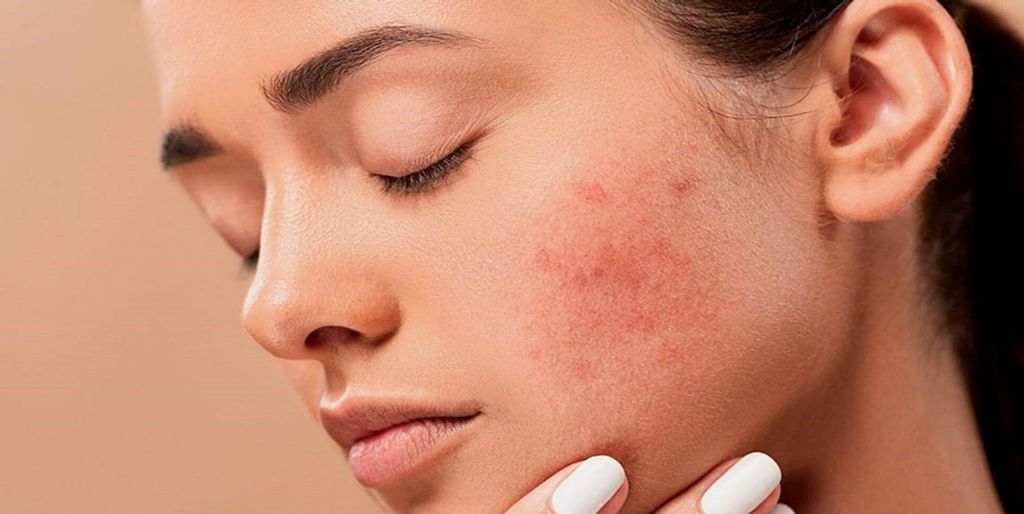 Chọn kem dưỡng ẩm cho da mụn khô nào phù hợp ? Cần lưu ý gì ?