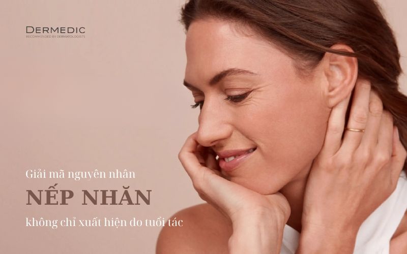 NẾP NHĂN KHÔNG CHỈ XUẤT HIỆN KHI DA LÃO HÓA!