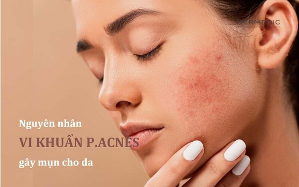 BẠN BIẾT GÌ VỀ P.ACNES - VI KHUẨN GÂY MỤN “KHÓ ƯA” CHO DA