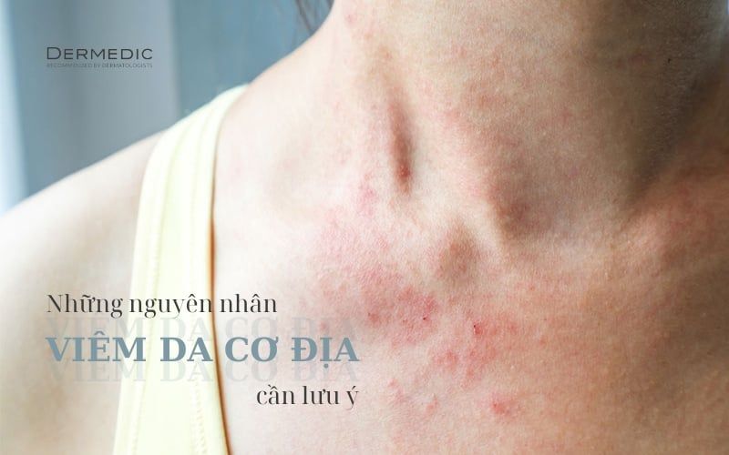 Cảnh báo: Những nguyên nhân viêm da cơ địa cần chú ý