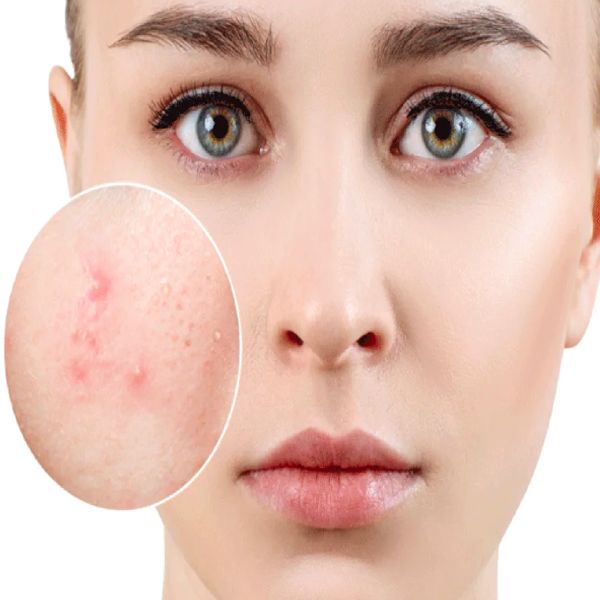 Sản phẩm dưỡng ẩm cho da mụn có thật sự cần thiết hay không ?