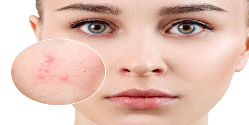 Mách bạn serum dưỡng ẩm cho da mụn và dòng điều trị hiệu quả