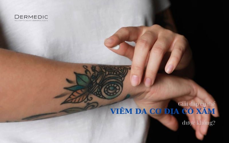 Giải đáp cụ thể viêm da cơ địa có xăm được không?