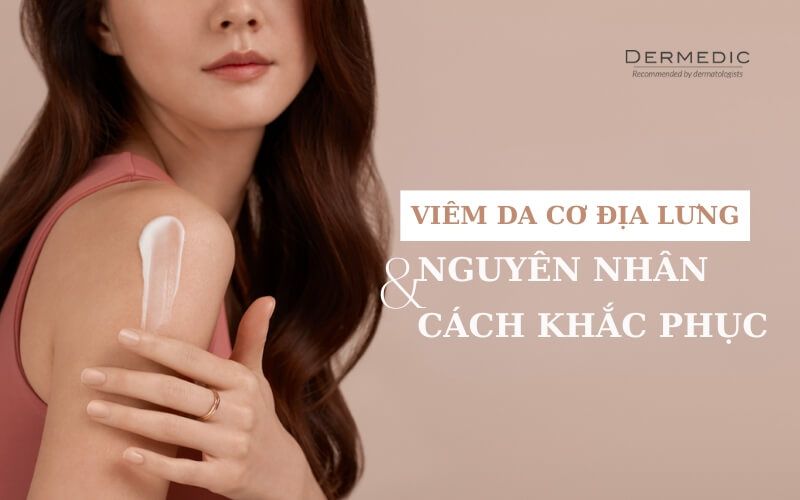 Viêm da cơ địa ở lưng – Vị trí tưởng chừng như không thể mắc phải bệnh
