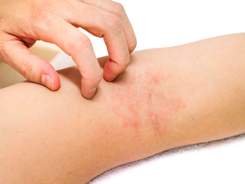 Viêm da cơ địa mùa hè là do đâu và nên khắc phục như thế nào?