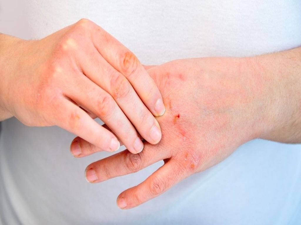 Viêm da cơ địa tay: Nên dùng sản phẩm dưỡng da nào phù hợp?