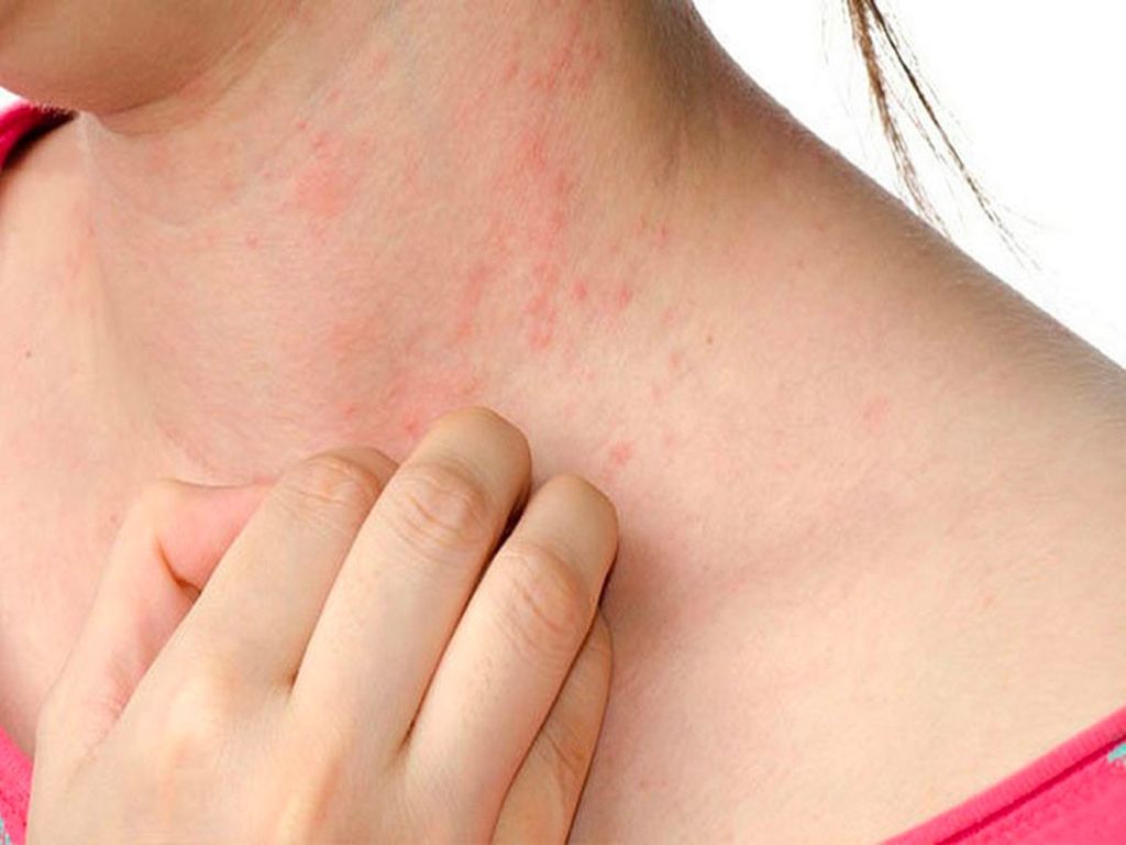 Viêm da có lây không, cách chữa trị như thế nào là hiệu quả?