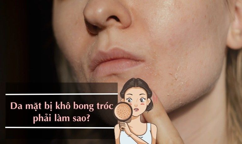DA MẶT BỊ KHÔ BONG TRÓC PHẢI LÀM SAO? CÁCH NGĂN NGỪA VÀ CHĂM SÓC