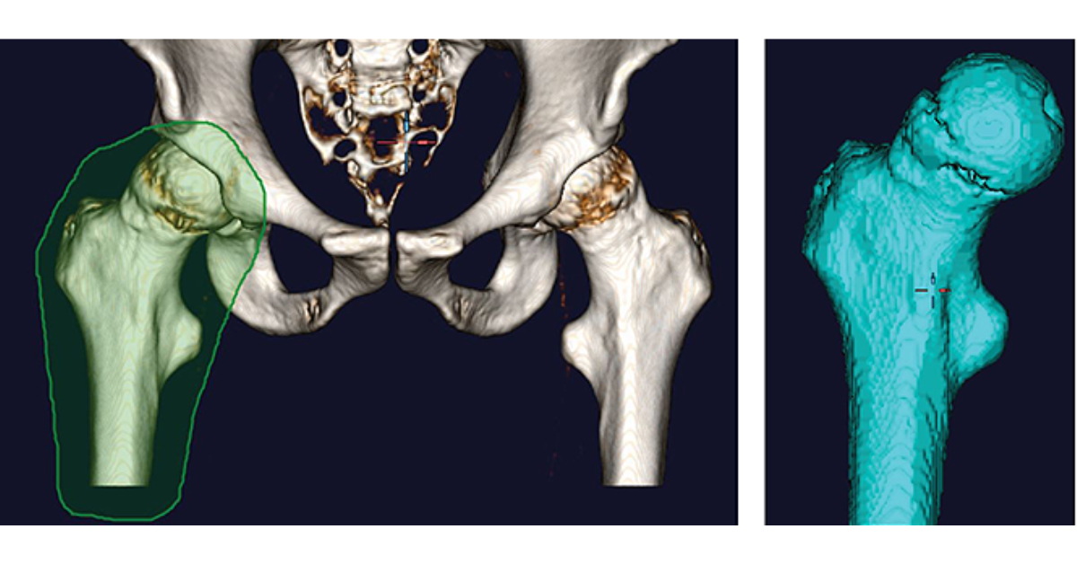 In 3D trong y học và những ứng dụng trong ngành y tế In 3D trong y học và những ứng dụng trong ngành y tế