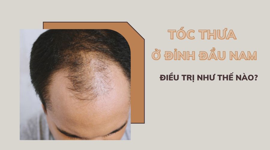 Rụng tóc nhiều ở nam Nguyên nhân dấu hiệu và cách điều trị