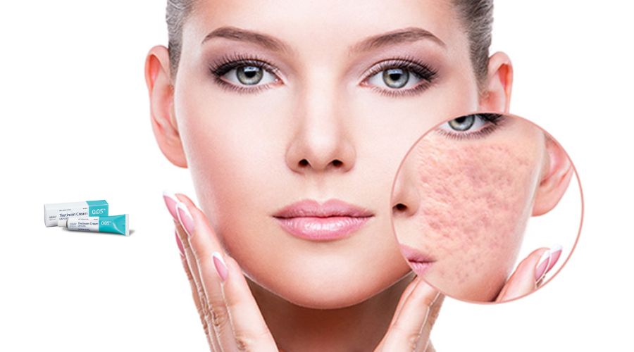 tretinoin-tri-seo-ro-1