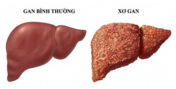 Ung thư gan