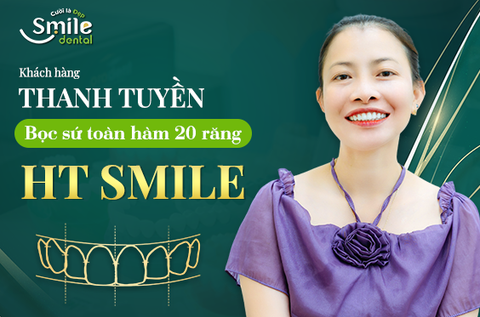 Chị Thanh Tuyền bọc 20 răng sứ HT Smile