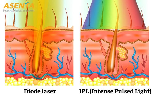 Tia laser hội tụ khi phát ra còn ánh sáng IPL bị phân tán sang những vùng xung quanh