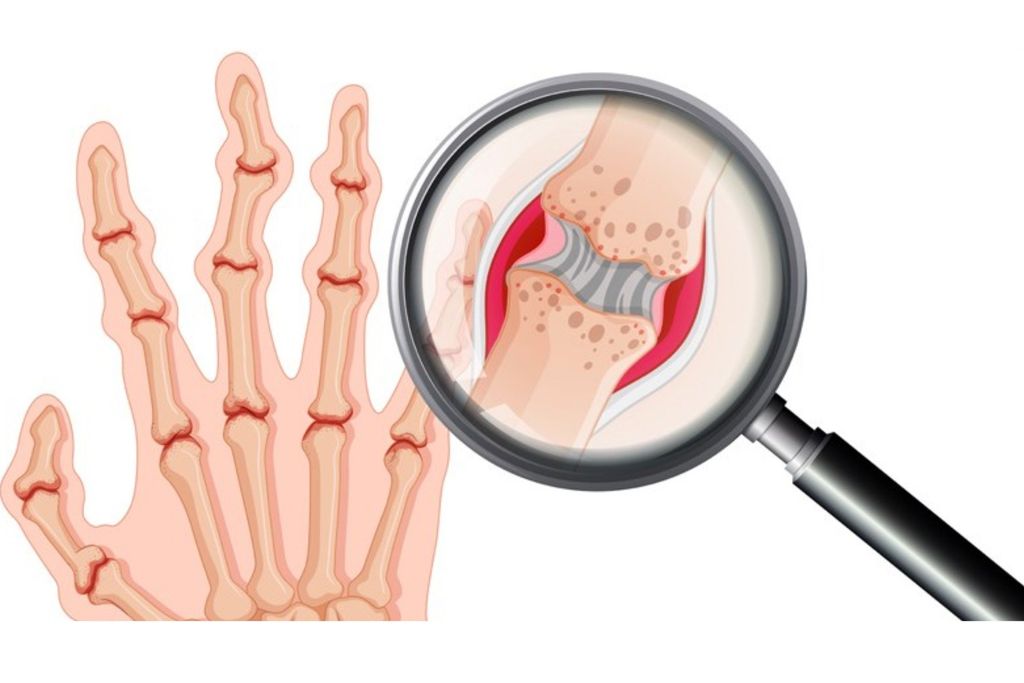HIỂU VỀ VIÊM KHỚP DẠNG THẤP