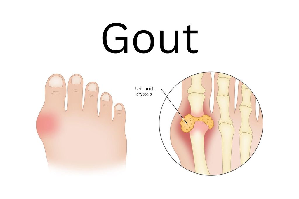 BỆNH GOUT – MỘT DẠNG VIÊM KHỚP ĐAU ĐỚN