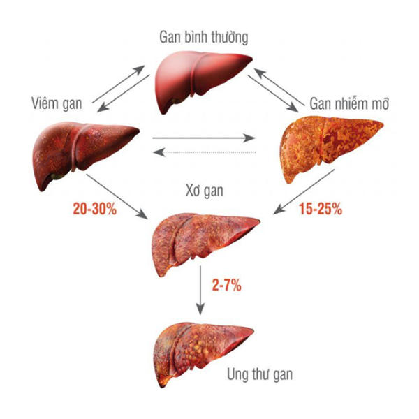 NHỮNG BỆNH LÝ THƯỜNG GẶP Ở GAN