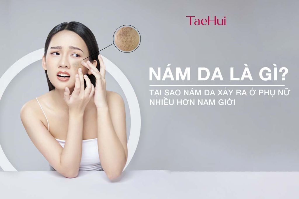 Nám da là gì? Tại sao nám da xảy ra ở phụ nữ nhiều hơn nam giới