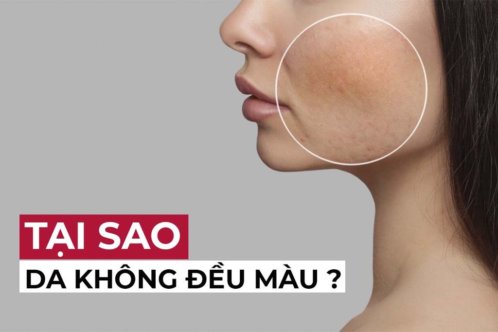 Tại sao da không đều màu? Và 5 cách khắc phục da không đều màu